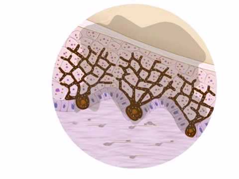 Video Slide Explanation of how Spectra Laser Toning works for Melasma